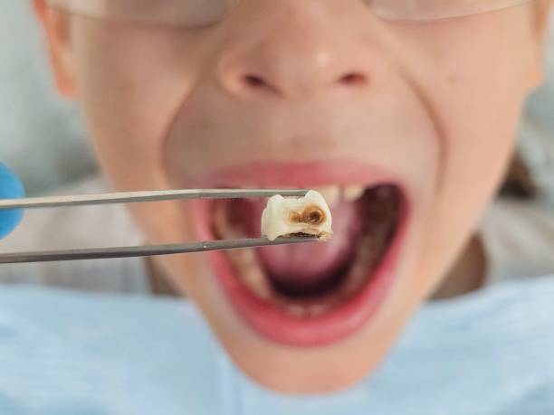 Best Dentist for Tooth Abscess  in Albany, TX